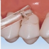 Cure-Thru Cervical Matrices
