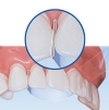Stop Stripers - Mylar Anterior Bands with Integrated Stopper